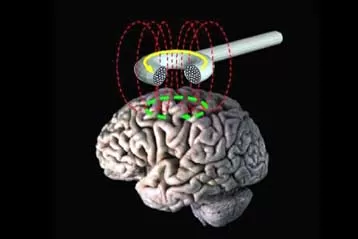 Θεραπεία με μαγνητικά πεδία αποτελεσματική κατά της κατάθλιψης
